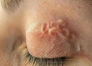 У Сумах виявили рідкісне паразитарне захворювання – дирофіляріоз