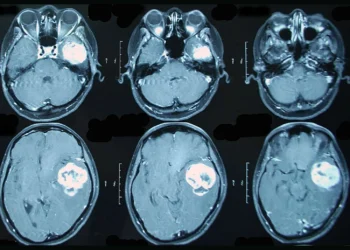 Внутрішньочерепні гематоми