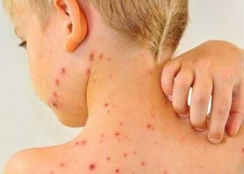 На Сумщині не фіксувалися випадки кору в останні два роки