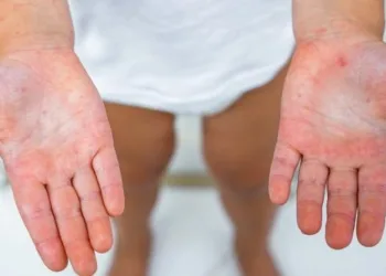 В Охтирці зафіксовано випадки корости та скарлатини