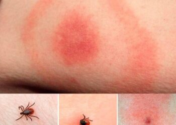 На Сумщині за перше півріччя цього року зареєстровано 158 хворих на кліщовий бореліоз