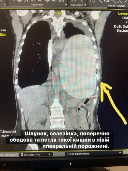 В Охтирці лікарі врятували пацієнтку з рідкісним розривом діафрагми