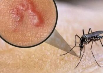 На Сумщині зафіксували перший цього року випадок дирофіляріозу: з ока жінки видалили 9-сантиметрового паразита