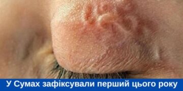 У Сумах зафіксували перший цього року випадок дирофіляріозу